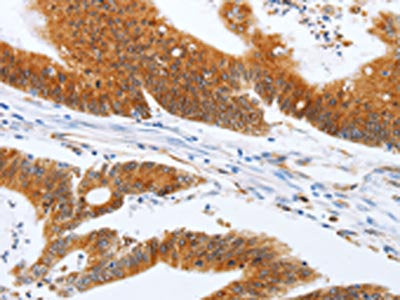 The image on the left is immunohistochemistry of paraffin-embedded Human colon cancer tissue using the antibody Antibody) at dilution 1/20, on the right is treated with fusion protein. (Original magnification: ×200)