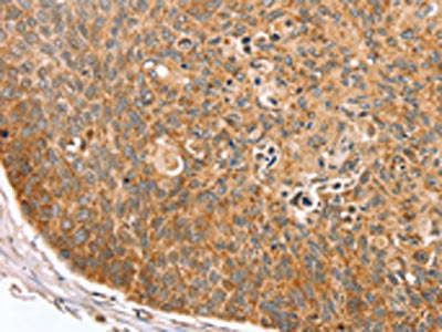 The image on the left is immunohistochemistry of paraffin-embedded Human esophagus cancer tissue using TRIM62 Antibody(TRIM62 Antibody) at dilution 1/30, on the right is treated with synthetic peptide. (Original magnification: ×200)Rabbit anti-Human TRIM62 Polyclonal Antibody