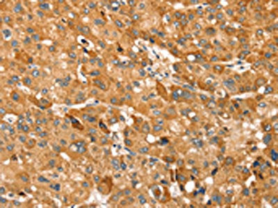 The image on the left is immunohistochemistry of paraffin-embedded Human liver cancer tissue using the antibody Antibody) at dilution 1/30, on the right is treated with synthetic peptide. (Original magnification: ×200)Rabbit anti-Human TRIM62 Polyclonal Antibody