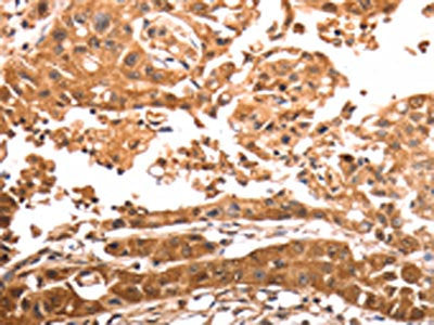 The image on the left is immunohistochemistry of paraffin-embedded Human lung cancer tissue using SLC39A6 Antibody(SLC39A6 Antibody) at dilution 1/30, on the right is treated with synthetic peptide. (Original magnification: ×200)Rabbit anti-Human SLC39A6 Polyclonal Antibody