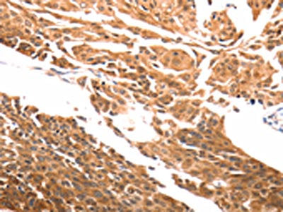 The image on the left is immunohistochemistry of paraffin-embedded Human cervical cancer tissue using the antibody Antibody) at dilution 1/30, on the right is treated with synthetic peptide. (Original magnification: ×200)Rabbit anti-Human SLC39A6 Polyclonal Antibody