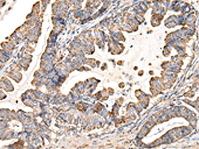The image on the left is immunohistochemistry of paraffin-embedded Human esophagus cancer tissue using UQCRC1 Antibody(UQCRC1 Antibody) at dilution 1/35, on the right is treated with fusion protein. (Original magnification: ×200)Rabbit anti-Human UQCRC1 Polyclonal Antibody