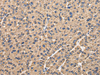 The image on the left is immunohistochemistry of paraffin-embedded Human liver cancer tissue using the antibody Antibody) at dilution 1/35, on the right is treated with fusion protein. (Original magnification: ×200)Rabbit anti-Human UQCRC1 Polyclonal Antibody