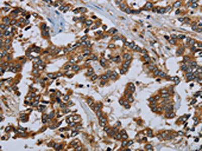 The image on the left is immunohistochemistry of paraffin-embedded Human liver cancer tissue using MIER2 Antibody(MIER2 Antibody) at dilution 1/50, on the right is treated with fusion protein. (Original magnification: ×200)
