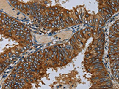 The image on the left is immunohistochemistry of paraffin-embedded Human colon cancer tissue using the antibody Antibody) at dilution 1/50, on the right is treated with fusion protein. (Original magnification: ×200)