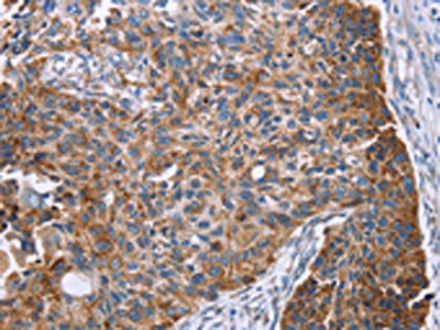 The image on the left is immunohistochemistry of paraffin-embedded Human esophagus cancer tissue using the antibody Antibody) at dilution 1/25, on the right is treated with fusion protein. (Original magnification: ×200)Rabbit anti-Human PMPCB Polyclonal Antibody