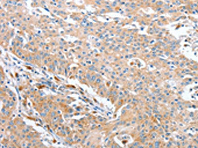 The image on the left is immunohistochemistry of paraffin-embedded Human gastric cancer tissue using WNT3A Antibody(WNT3A Antibody) at dilution 1/40, on the right is treated with fusion protein. (Original magnification: ×200)Rabbit anti-Human WNT3A Polyclonal Antibody
