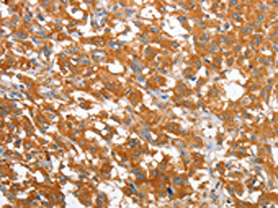 The image on the left is immunohistochemistry of paraffin-embedded Human thyroid cancer tissue using the antibody Antibody) at dilution 1/40, on the right is treated with fusion protein. (Original magnification: ×200)Rabbit anti-Human WNT3A Polyclonal Antibody