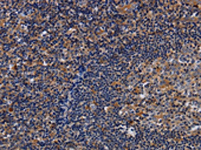 The image on the left is immunohistochemistry of paraffin-embedded Human tonsil tissue using LIMS1 Antibody(LIMS1 Antibody) at dilution 1/40, on the right is treated with fusion protein. (Original magnification: ×200)