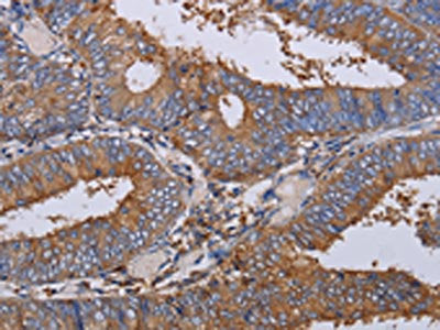 The image on the left is immunohistochemistry of paraffin-embedded Human colon cancer tissue using the antibody Antibody) at dilution 1/40, on the right is treated with fusion protein. (Original magnification: ×200)