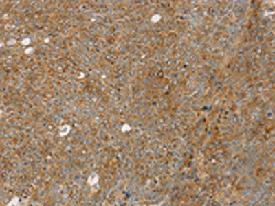 The image on the left is immunohistochemistry of paraffin-embedded Human ovarian cancer tissue using STX16 Antibody(STX16 Antibody) at dilution 1/30, on the right is treated with fusion protein. (Original magnification: ×200)Rabbit anti-Human STX16 Polyclonal Antibody
