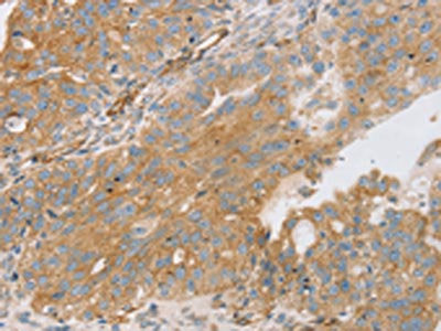 The image on the left is immunohistochemistry of paraffin-embedded Human breast cancer tissue using the antibody Antibody) at dilution 1/30, on the right is treated with fusion protein. (Original magnification: ×200)Rabbit anti-Human STX16 Polyclonal Antibody