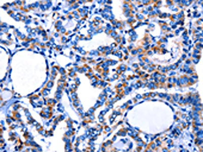 The image on the left is immunohistochemistry of paraffin-embedded Human thyroid cancer tissue using CTSH Antibody(CTSH Antibody) at dilution 1/5, on the right is treated with fusion protein. (Original magnification: ×200)Rabbit anti-Human CTSH Polyclonal Antibody