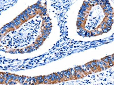 The image on the left is immunohistochemistry of paraffin-embedded Human colon cancer tissue using the antibody Antibody) at dilution 1/5, on the right is treated with fusion protein. (Original magnification: ×200)Rabbit anti-Human CTSH Polyclonal Antibody