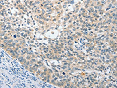 The image on the left is immunohistochemistry of paraffin-embedded Human cervical cancer tissue using UCHL5 Antibody(UCHL5 Antibody) at dilution 1/25, on the right is treated with fusion protein. (Original magnification: ×200)Rabbit anti-Human UCHL5 Polyclonal Antibody
