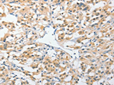 The image on the left is immunohistochemistry of paraffin-embedded Human thyroid cancer tissue using the antibody Antibody) at dilution 1/25, on the right is treated with fusion protein. (Original magnification: ×200)Rabbit anti-Human UCHL5 Polyclonal Antibody