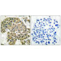 Immunohistochemical analysis of paraffin-embedded human breast carcinoma tissue using Mammaglobin B antibody.Rabbit anti-Human SCGB2A1 Polyclonal Antibody
