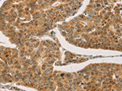 The image on the left is immunohistochemistry of paraffin-embedded Human breast cancer tissue using CPA2 Antibody(CPA2 Antibody) at dilution 1/20, on the right is treated with fusion protein. (Original magnification: ×200)Rabbit anti-Human CPA2 Polyclonal Antibody