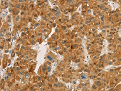 The image on the left is immunohistochemistry of paraffin-embedded Human liver cancer tissue using the antibody Antibody) at dilution 1/20, on the right is treated with fusion protein. (Original magnification: ×200)Rabbit anti-Human CPA2 Polyclonal Antibody
