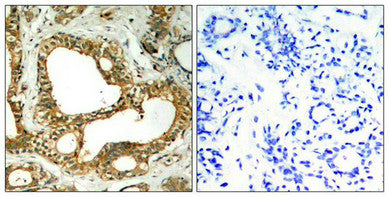 Immunohistochemical analysis of paraffin-embedded human breast carcinoma tissue using SHP-1(Ab-536) Antibody(left) or the same antibody preincubated with blocking peptide(right).Rabbit anti-Human PTPN6 Polyclonal Antibody