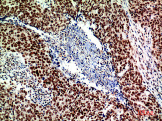 Immunohistochemical analysis of paraffin-embedded human-breast-cancer, antibody was diluted at 1:200