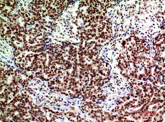 Immunohistochemical analysis of paraffin-embedded human-breast-cancer, antibody was diluted at 1:200