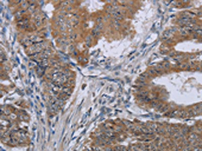 The image on the left is immunohistochemistry of paraffin-embedded Human esophagus cancer tissue using KLHL2 Antibody(KLHL2 Antibody) at dilution 1/20, on the right is treated with fusion protein. (Original magnification: ×200)
