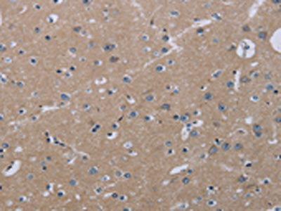 The image on the left is immunohistochemistry of paraffin-embedded Human brain tissue using the antibody Antibody) at dilution 1/20, on the right is treated with fusion protein. (Original magnification: ×200)