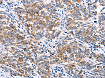 The image on the left is immunohistochemistry of paraffin-embedded Human breast cancer tissue using CLDN3 Antibody(CLDN3 Antibody) at dilution 1/25, on the right is treated with synthetic peptide. (Original magnification: ×200)Rabbit anti-Human CLDN3 Polyclonal Antibody