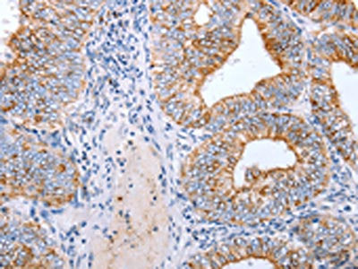 The image on the left is immunohistochemistry of paraffin-embedded Human cervical cancer tissue using the antibody Antibody) at dilution 1/25, on the right is treated with synthetic peptide. (Original magnification: ×200)Rabbit anti-Human CLDN3 Polyclonal Antibody
