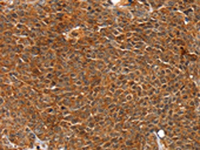 The image on the left is immunohistochemistry of paraffin-embedded Human ovarian cancer tissue using ANKRD1 Antibody(ANKRD1 Antibody) at dilution 1/20, on the right is treated with fusion protein. (Original magnification: ×200)Rabbit anti-Human ANKRD1 Polyclonal Antibody