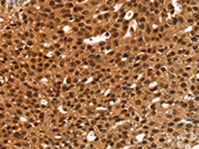 The image on the left is immunohistochemistry of paraffin-embedded Human breast cancer tissue using the antibody Antibody) at dilution 1/20, on the right is treated with fusion protein. (Original magnification: ×200)Rabbit anti-Human ANKRD1 Polyclonal Antibody