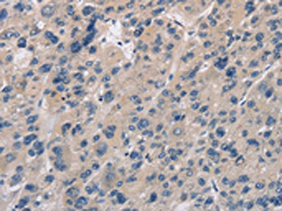 The image on the left is immunohistochemistry of paraffin-embedded Human liver cancer tissue using IMPDH1 Antibody(IMPDH1 Antibody) at dilution 1/20, on the right is treated with synthetic peptide. (Original magnification: ×200)Rabbit anti-Human IMPDH1 Polyclonal Antibody