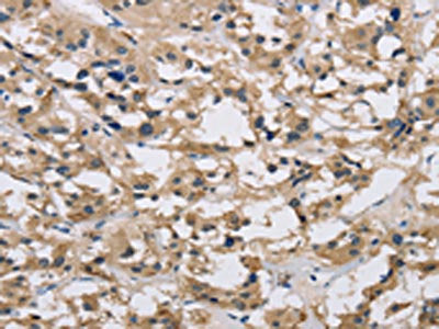 The image on the left is immunohistochemistry of paraffin-embedded Human thyroid cancer tissue using the antibody Antibody) at dilution 1/20, on the right is treated with synthetic peptide. (Original magnification: ×200)Rabbit anti-Human IMPDH1 Polyclonal Antibody