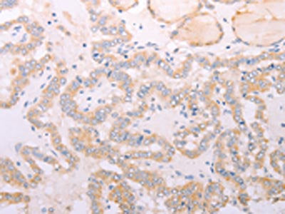 The image on the left is immunohistochemistry of paraffin-embedded Human thyroid cancer tissue using ADIPOR1 Antibody(ADIPOR1 Antibody) at dilution 1/20, on the right is treated with fusion protein. (Original magnification: X200)