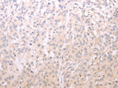 The image on the left is immunohistochemistry of paraffin-embedded Human esophagus cancer tissue using the antibody Antibody) at dilution 1/20, on the right is treated with fusion protein. (Original magnification: X200)