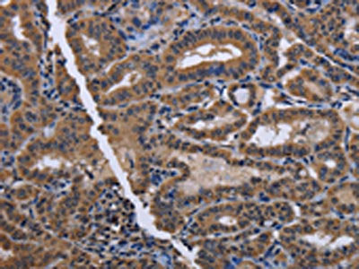 The image on the left is immunohistochemistry of paraffin-embedded Human thyroid cancer tissue using the antibody Antibody) at dilution 1/40, on the right is treated with fusion protein. (Original magnification: ×200)Rabbit anti-Human CYP3A4 Polyclonal Antibody