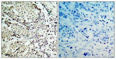 Immunohistochemical analysis of paraffin-embedded human breast carcinoma tissue using MKK3(Ab-189) Antibody(left) or the same antibody preincubated with blocking peptide(right).