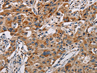The image on the left is immunohistochemistry of paraffin-embedded Human lung cancer tissue using MMP1 Antibody(MMP1 Antibody) at dilution 1/60, on the right is treated with fusion protein. (Original magnification: ×200)Rabbit anti-Human MMP1 Polyclonal Antibody