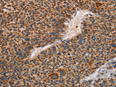 The image on the left is immunohistochemistry of paraffin-embedded Human liver cancer tissue using the antibody Antibody) at dilution 1/60, on the right is treated with fusion protein. (Original magnification: ×200)