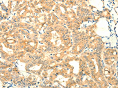 The image on the left is immunohistochemistry of paraffin-embedded Human thyroid cancer tissue using SNAP25 Antibody(SNAP25 Antibody) at dilution 1/25, on the right is treated with fusion protein. (Original magnification: ×200)Rabbit anti-Human SNAP25 Polyclonal Antibody