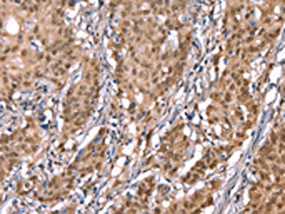 The image on the left is immunohistochemistry of paraffin-embedded Human gastic cancer tissue using the antibody Antibody) at dilution 1/40, on the right is treated with synthetic peptide. (Original magnification: ×200)