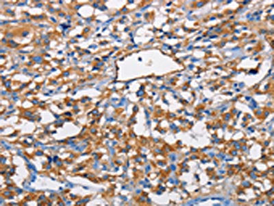 The image on the left is immunohistochemistry of paraffin-embedded Human thyroid cancer tissue using NT5E Antibody(NT5E Antibody) at dilution 1/40, on the right is treated with fusion protein. (Original magnification: ×200)Rabbit anti-Human NT5E Polyclonal Antibody