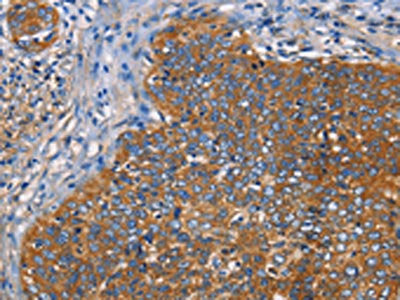 The image on the left is immunohistochemistry of paraffin-embedded Human cervical cancer tissue using the antibody Antibody) at dilution 1/40, on the right is treated with fusion protein. (Original magnification: ×200)Rabbit anti-Human NT5E Polyclonal Antibody