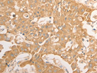 The image on the left is immunohistochemistry of paraffin-embedded Human lung cancer tissue using NAP1L1 Antibody(NAP1L1 Antibody) at dilution 1/50, on the right is treated with fusion protein. (Original magnification: ×200)Rabbit anti-Human NAP1L1 Polyclonal Antibody