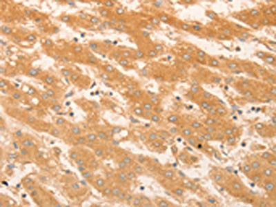 The image on the left is immunohistochemistry of paraffin-embedded Human liver cancer tissue using the antibody Antibody) at dilution 1/50, on the right is treated with fusion protein. (Original magnification: ×200)Rabbit anti-Human NAP1L1 Polyclonal Antibody