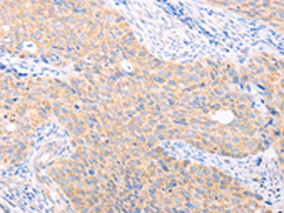 The image on the left is immunohistochemistry of paraffin-embedded Human cervical cancer tissue using the antibody Antibody) at dilution 1/40, on the right is treated with fusion protein. (Original magnification: ×200)Rabbit anti-Human TRIM32 Polyclonal Antibody
