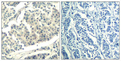 Immunohistochemical analysis of paraffin-embedded human breast carcinoma tissue using ABL1/2(Phospho-Tyr393/439) Antibody(left) or the same antibody preincubated with blocking peptide(right).Rabbit anti-Human ABL1/ABL2 Polyclonal Antibody