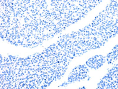 The image on the left is immunohistochemistry of paraffin-embedded Human liver cancer tissue using the antibody Antibody) at dilution 1/6, on the right is treated with synthetic peptide. (Original magnification: ×200)Rabbit anti-Human MT-CO2 Polyclonal Antibody