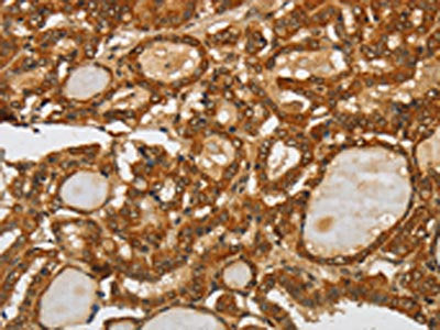 The image on the left is immunohistochemistry of paraffin-embedded Human thyroid cancer tissue using SPHK2 Antibody(SPHK2 Antibody) at dilution 1/80, on the right is treated with fusion protein. (Original magnification: ×200)Rabbit anti-Human SPHK2 Polyclonal Antibody